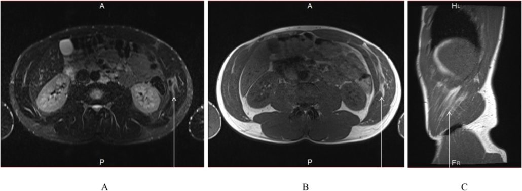 MRI of oblique tear in pro tennis player before initiating return-to-play methods with 1080 Quantum.